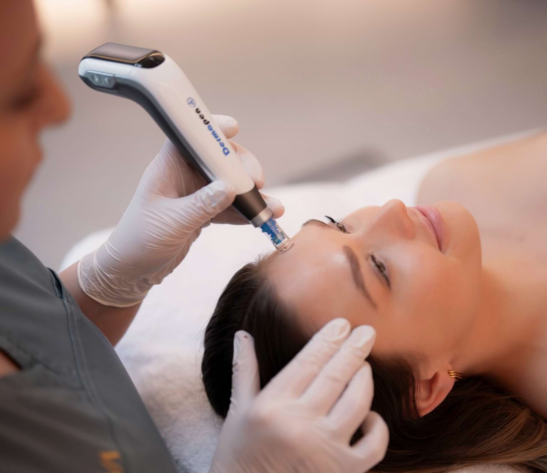 Microneedling: Professional treatment in Berlin for radiant skin.